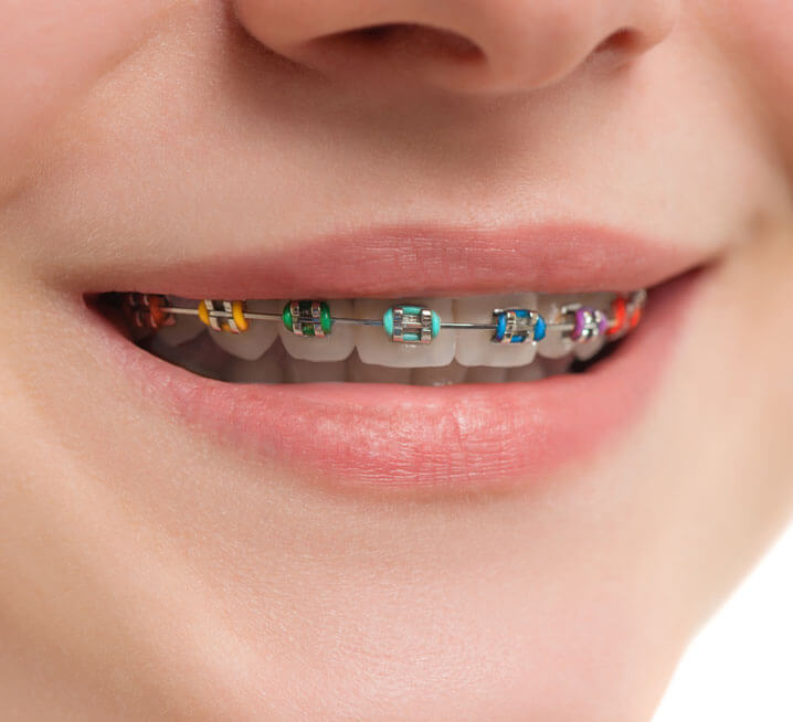 Insignia braces