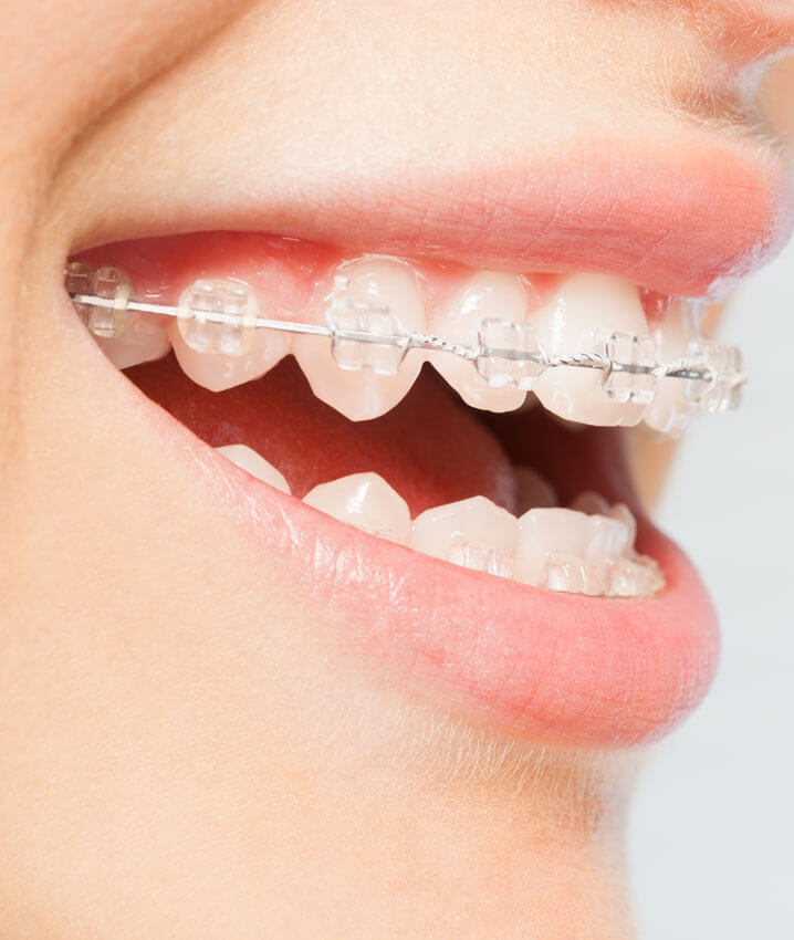 Insignia braces