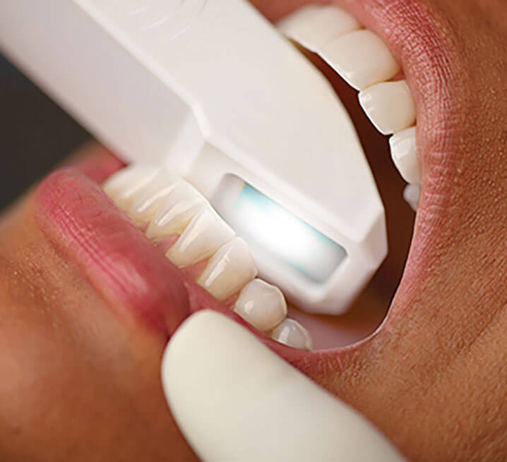 iTero: Intra oral digital scanner