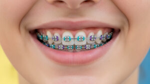 Teen smiling with traditional metal braces during orthodontic treatment for a healthier smile.